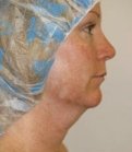 Necklift Case 2 - before