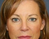 Upper Eyelids Removal Sagging Skin - before