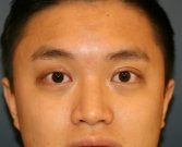 Double Eyelid (Asian) - after