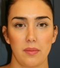 Revision Rhinoplasty - after