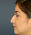 female nose surgery san diego - before