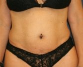 Tummy-Tuck-and-Liposuction-Waist - before