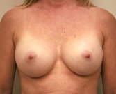 Breast Augmentation Case 15 - after