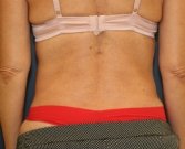 Liposuction Waist - after