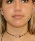 Liposuction Lower Cheeks - after