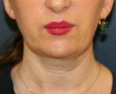Lipo Lower Face, Neck, & Chin Implant - before