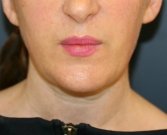Neck and Lower Face Lipo - after