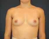 650 ml Ultra High Profile Breast Implants - before