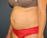 Tummy Tuck (3 kids) - before
