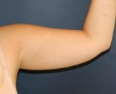 Arm Liposuction San Diego - before