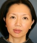 Asian Eyelid Crease - before