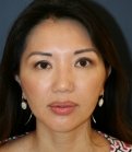 Asian Eyelid Crease - after