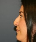 Rhinoplasty San Diego 70 - before