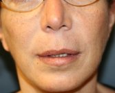 Upper Lip Lift 150 - before