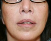Upper Lip Lift 150 - after