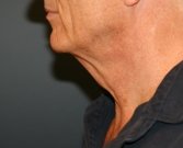 Neck Lift San Diego 36 - before