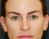 Procedure to Open Eyelids Slightly - after