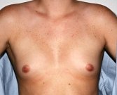 Breast Augmentation Case 17 - before