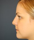 Rhinoplasty San Diego 73 - before