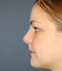 Rhinoplasty San Diego 73 - after