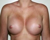 Breast Augmentation Case 17 - after