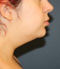 Neck Liposuction and Weight Loss - before