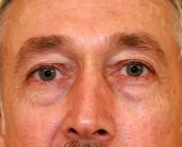 Blepharoplasty Case 1 - before
