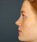 Rhinoplasty San Diego 75 - after