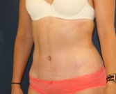 Tummy Tuck San Diego 100 - after