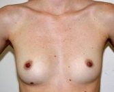 Breast Augmentation Case 18 - before
