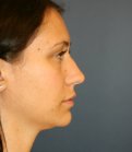 Rhinoplasty San Diego 133 - before