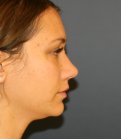 Rhinoplasty San Diego 133 - after