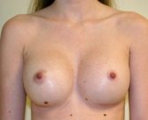 Breast Augmentation Case 18 - after