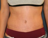 Tummy Tuck San Diego 101 - after