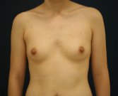 Natural Breast Augmentation 10 - before