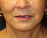 Upper Lip Lift Chin Implant - before