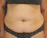 Tummy Tuck San Diego 102 - before