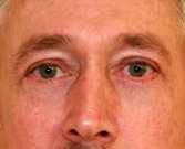Blepharoplasty Case 1 - after