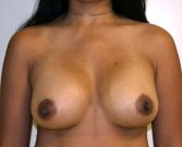 Breast Augmentation Case 19 - after