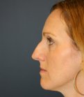 Rhinoplasty (bump on nose) - before