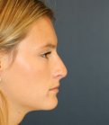 Rhinoplasty teen-age San Diego - before