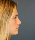 Rhinoplasty teen-age San Diego - after