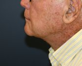 Male \"Turkey Gobbler\" Neck Lift - after