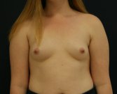 Breast Augmentation-455cc Sientra - before