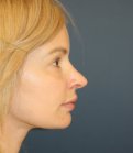 Revision Rhinoplasty 82 - before