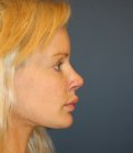 Revision Rhinoplasty 82 - after