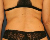 Waist Liposuction - before