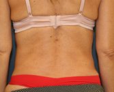 Waist Liposuction - after