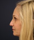Rhinoplasty-San-Diego 224 - before