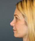 Rhinoplasty-San-Diego 224 - after